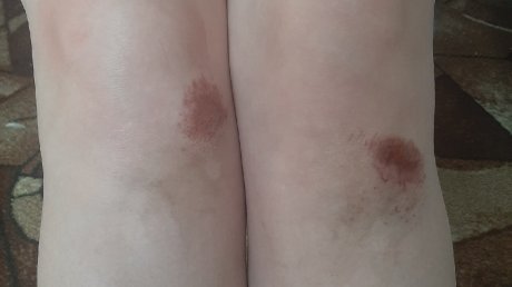 В Кузнецке девочка травмировалась повешенной водителями цепью